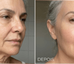 Resultado PDRN rejuvenescimento